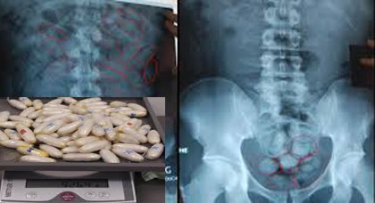 الدار البيضاء : تفريغ 670 غراما من الكوكايين من أمعاء مواطنة برازيلية