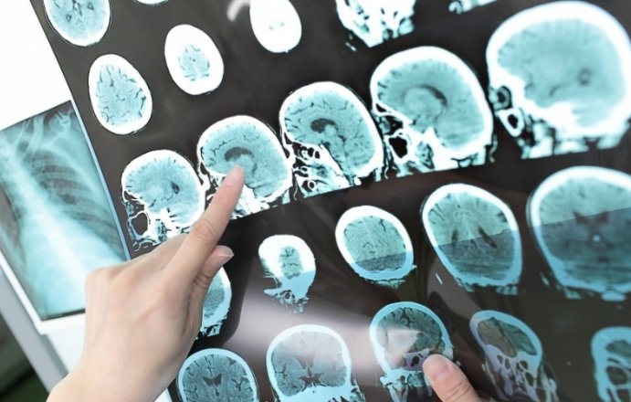 السكتة الدماغية.. وفاة ضحية واحدة كل 17 دقيقة بالمغرب   