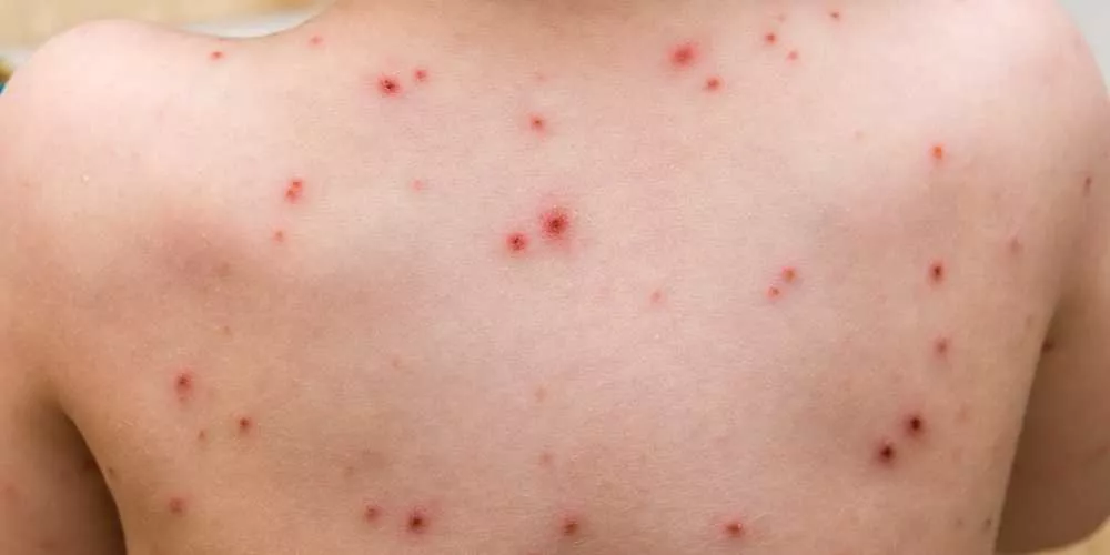 جذري القردة..تماثل 43 حالة للشفاء في كوت ديفوار (حصيلة جديدة)