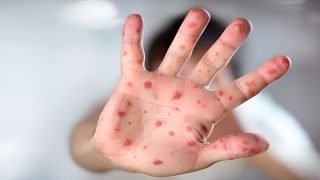 الهند تعلن تسجيل حالة إصابة مشتبهة بجدري القردة