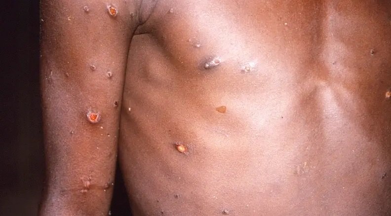تفشي مميت.. الكونغو الديمقراطية تتلقى أول دفعة من لقاحات جدري القرود لكبح الكارثة