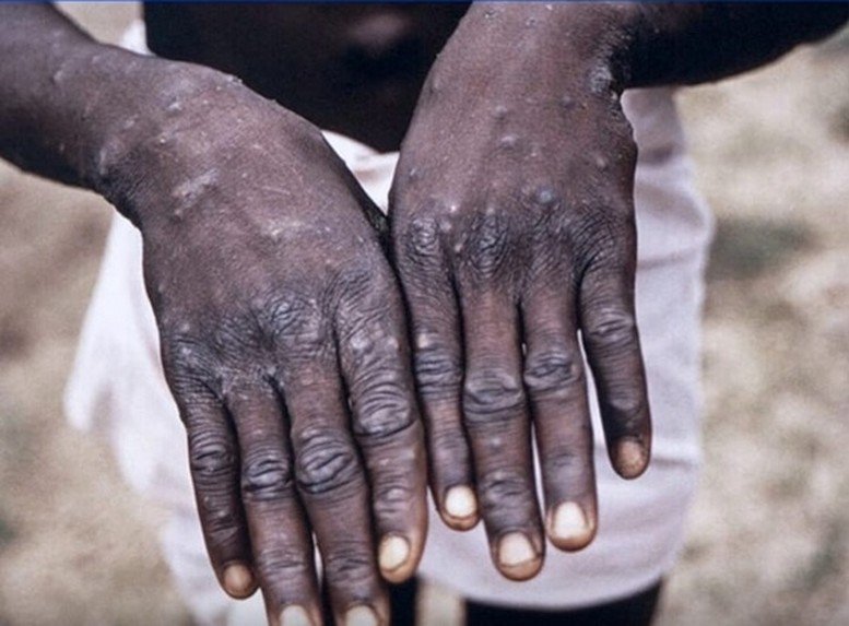 أزيد من 2700 حالة إصابة جديدة بجدري القردة في إفريقيا في ظرف أسبوع