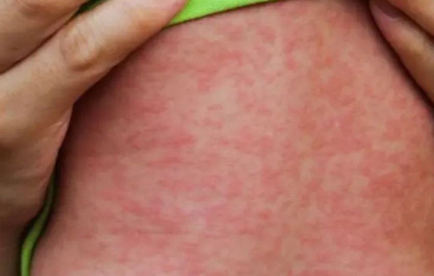 وزارة الصحة تعول على تعميم التلقيح لمواجهة داء الحصبة
