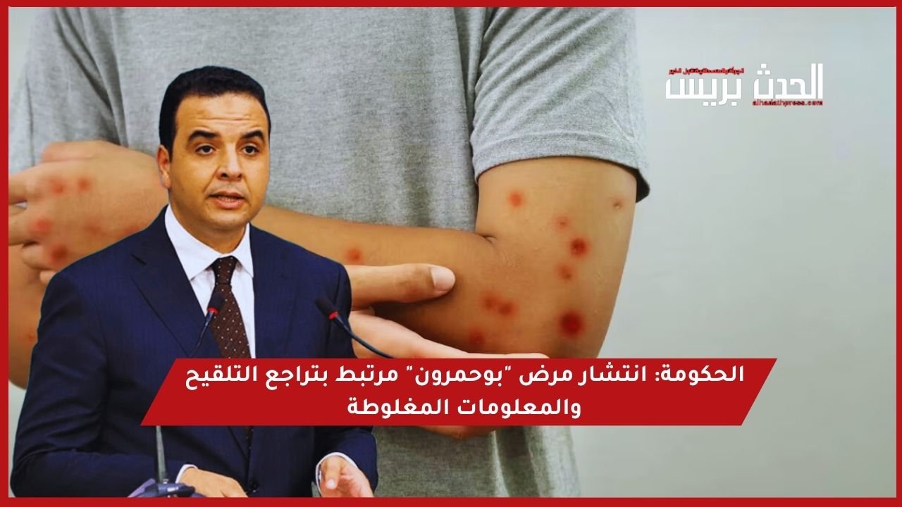 الحكومة: انتشار مرض “بوحمرون” مرتبط بتراجع التلقيح والمعلومات المغلوطة ـ (فيديو)
