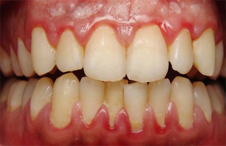 أمراض اللثة تزيد من مخاطر الإصابة بالزهايمر (دراسة)