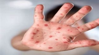 منظمة الصحة العالمية: جدري القردة يظل تهديدًا عالميًا