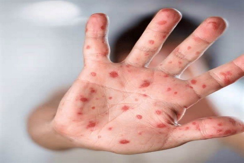 منظمة الصحة العالمية: جدري القردة يظل تهديدًا عالميًا