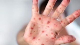 الجديدة: المدارس تحث الأسر على تلقيح أبنائها ضد”بوحمرون”